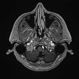 Cerebral arteriovenous malformation (Radiopaedia 84015-99245 Axial T1 C+ 28).jpg