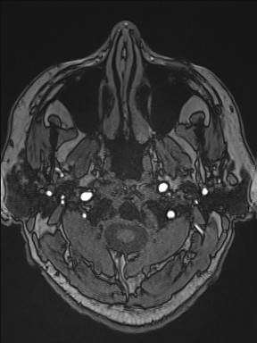 Cerebral arteriovenous malformation (Radiopaedia 84015-99245 Axial TOF 24).jpg