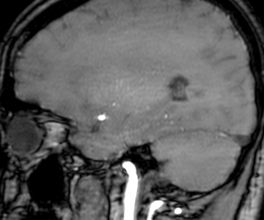Cerebral arteriovenous malformation at posterior body of corpus callosum (Radiopaedia 74111-84925 J 278).jpg