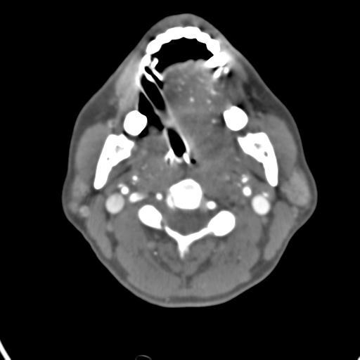 Cerebral arteriovenous malformation with hemorrhage (Radiopaedia 28773-29073 A 61).jpg