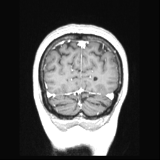Cerebral arteriovenous malformation with hemorrhage (Radiopaedia 34422-35737 Coronal T1 C+ 17).png