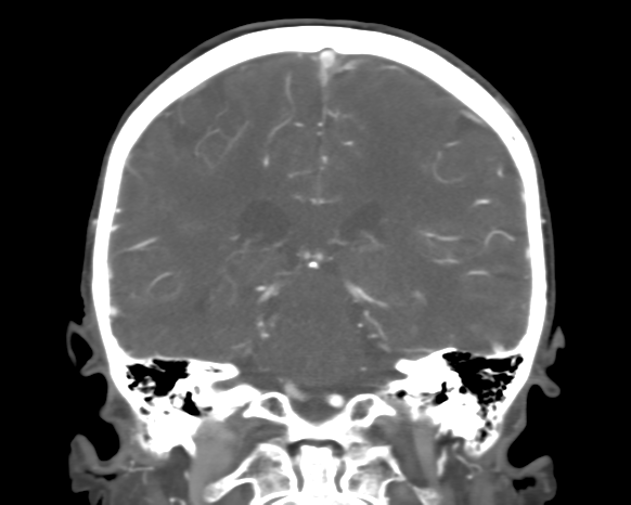 Cerebral arteriovenous malformation with lobar hemorrhage (Radiopaedia 44725-48511 A 36).png