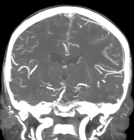 Cerebral arteriovenous malformation with lobar hemorrhage (Radiopaedia 44725-48511 B 31).png