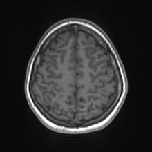 Cerebral cavernous venous malformation (Radiopaedia 70008-80021 Axial T1 69).jpg