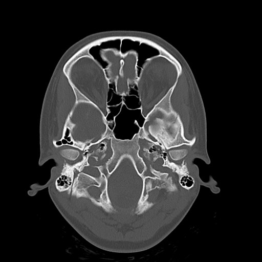 Cerebral cavernous venous malformation (Radiopaedia 70008-80022 Axial bone window 5).jpg