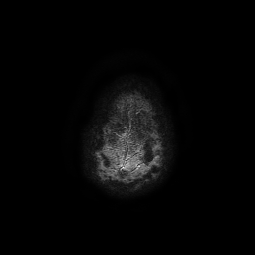 Cerebral cavernous venous malformation (Zabramski type II) (Radiopaedia 85511-101198 Axial SWI 120).jpg