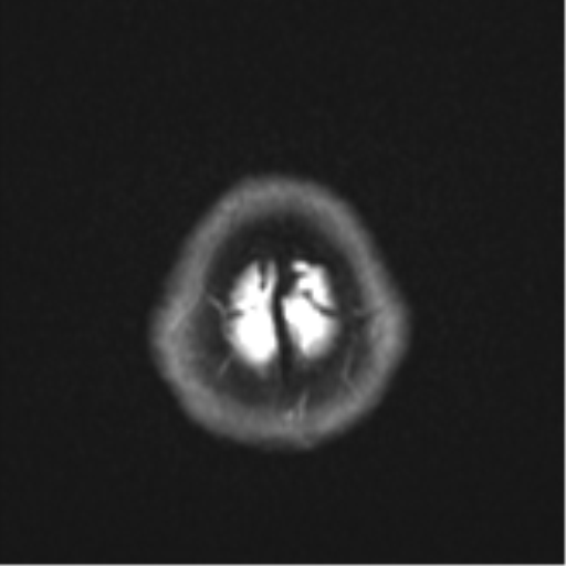 Cerebral cavernous venous malformations (Radiopaedia 48117-52946 Axial DWI 27).png