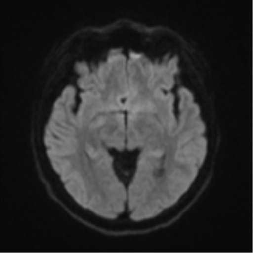 Cerebral cavernous venous malformations (Radiopaedia 48117-52946 Axial DWI 40).png