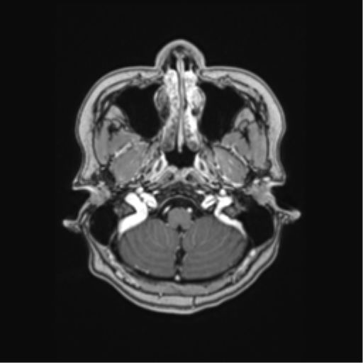 File:Cerebral cavernous venous malformations (Radiopaedia 48117-52946 Axial T1 C+ 2).png