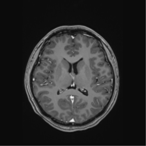Cerebral cavernous venous malformations (Radiopaedia 48117-52946 Axial T1 C+ 34).png