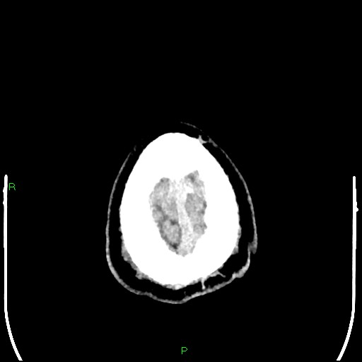 Cerebral contusions (Radiopaedia 33868-35039 Axial non-contrast 211).jpg