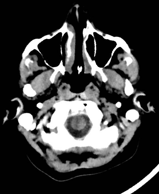 Cerebral edema due to severe hyponatremia (Radiopaedia 89826-106937 Axial non-contrast 6).jpg