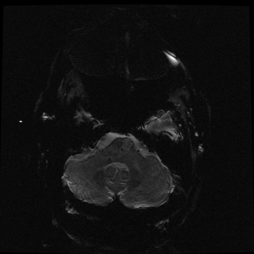Cerebral embolic infarcts (embolic shower) (Radiopaedia 49837-55108 Axial SWI 58).jpg