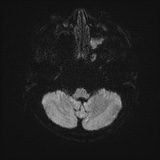 File:Cerebral embolic infarcts (embolic shower) (Radiopaedia 72391-82921 Axial DWI 35).jpg