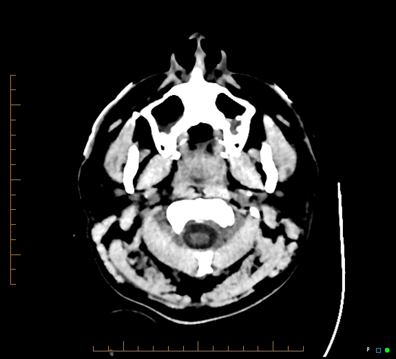 Cerebral fat embolism (Radiopaedia 85521-101220 Axial non-contrast 5).jpg