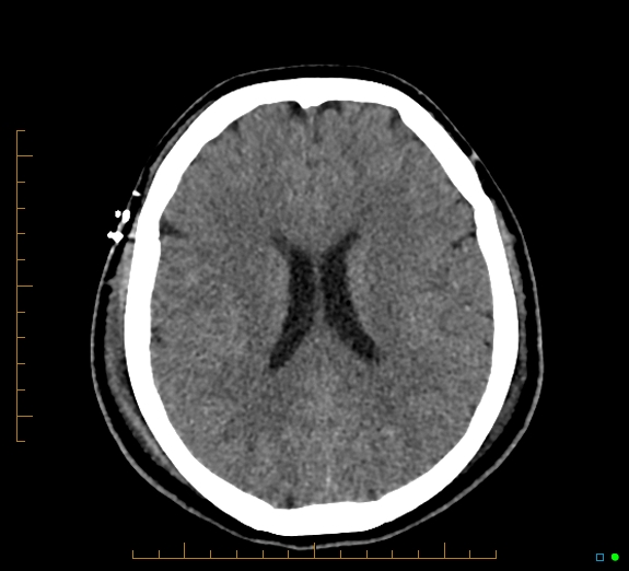 File:Cerebral fat embolism (Radiopaedia 85521-101224 Axial non-contrast 32).jpg