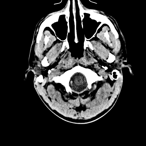 File:Cerebral hemorrhagic contusions- temporal evolution (Radiopaedia 40224-42753 Axial non-contrast 2).png