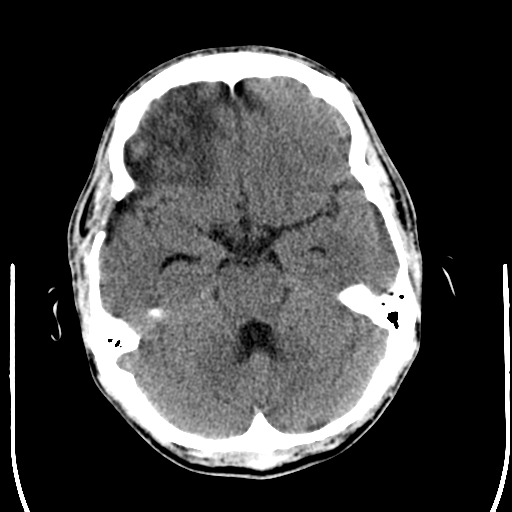 File:Cerebral hemorrhagic contusions- temporal evolution (Radiopaedia 40224-42756 Axial non-contrast 8).png