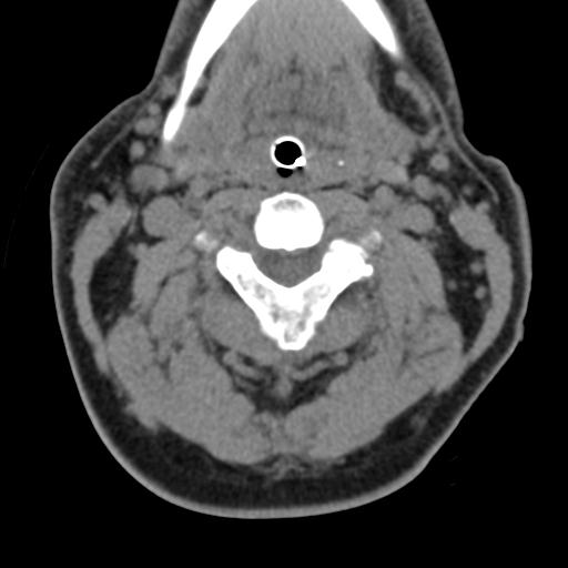 Cerebral hemorrhagic contusions and cervical spine fractures (Radiopaedia 32865-33841 F 21).jpg
