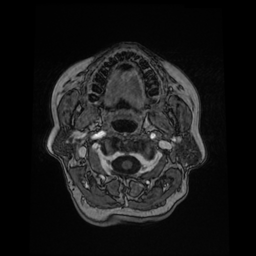 Cerebral metastases - melanoma (Radiopaedia 80972-94522 Axial T1 C+ 15).jpg