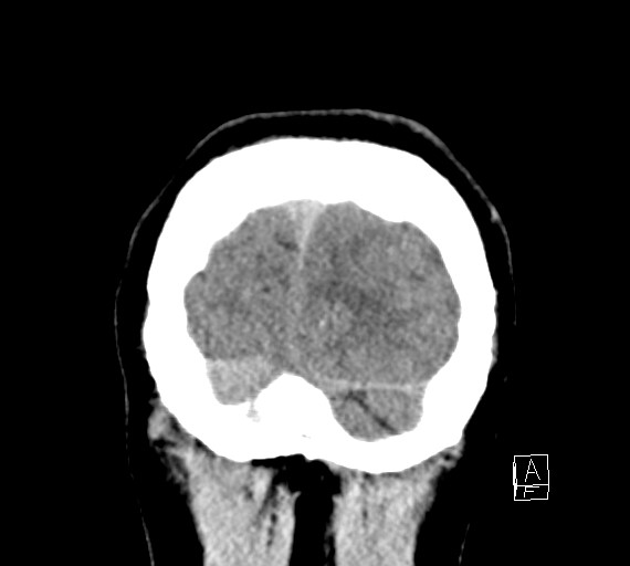 Cerebral metastases - testicular choriocarcinoma (Radiopaedia 84486-99855 Coronal C+ delayed 58).jpg
