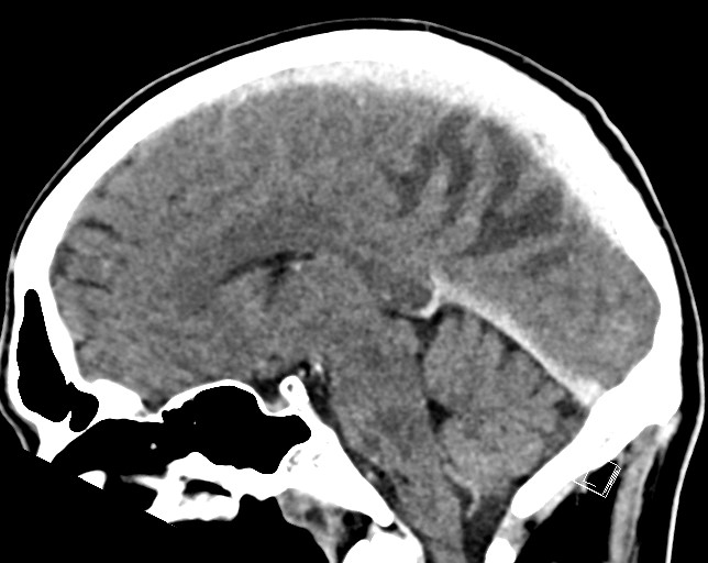 Cerebral metastases - testicular choriocarcinoma (Radiopaedia 84486-99855 F 29).jpg