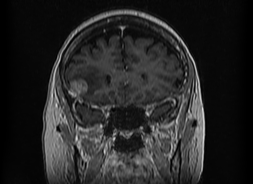 Cerebral metastases from lung cancer with amyloid angiopathy and cerebellopontine angle meningioma (Radiopaedia 74306-85191 Coronal T1 C+ 17).jpg