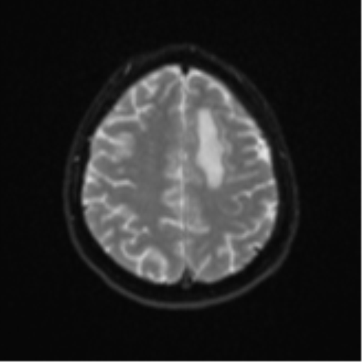 Cerebral metastases mimicking abscesses (Radiopaedia 45841-50131 Axial DWI 22).png