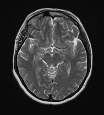File:Cerebral metastases mimicking abscesses (Radiopaedia 45841-50131 Axial T2 13).png