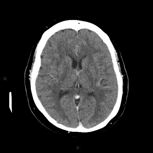 File:Cerebral metastasis from renal cell carcinoma (Radiopaedia 82306-96375 Axial C+ delayed 21).jpg