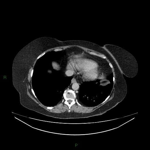 Cerebral metastasis from renal cell carcinoma (Radiopaedia 82306-96378 A 16).jpg