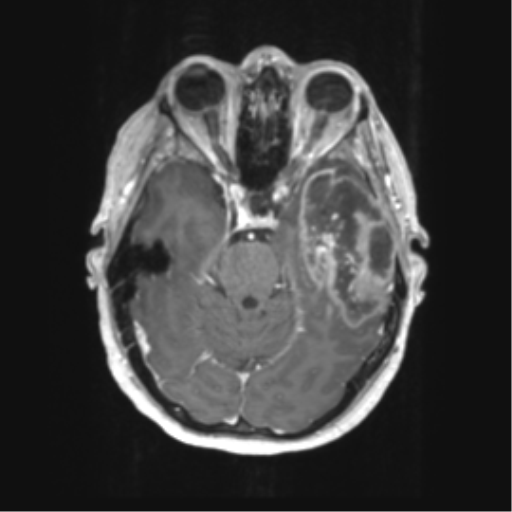File:Cerebral metastasis mimicking glioblastoma (Radiopaedia 69155-78937 Axial T1 C+ 19).png