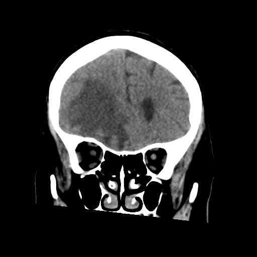 Cerebral metastasis to basal ganglia (Radiopaedia 81568-95412 Coronal non-contrast 22).png
