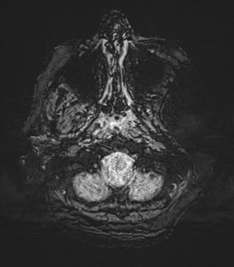 Cerebral metastasis to basal ganglia (Radiopaedia 81568-95413 Axial SWI 5).png