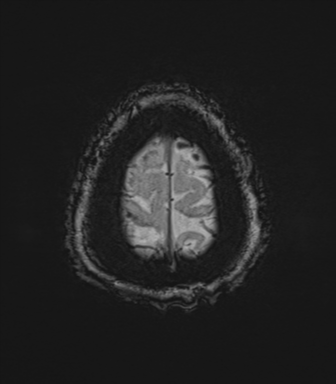 Cerebral metastasis to basal ganglia (Radiopaedia 81568-95413 Axial SWI 83).png