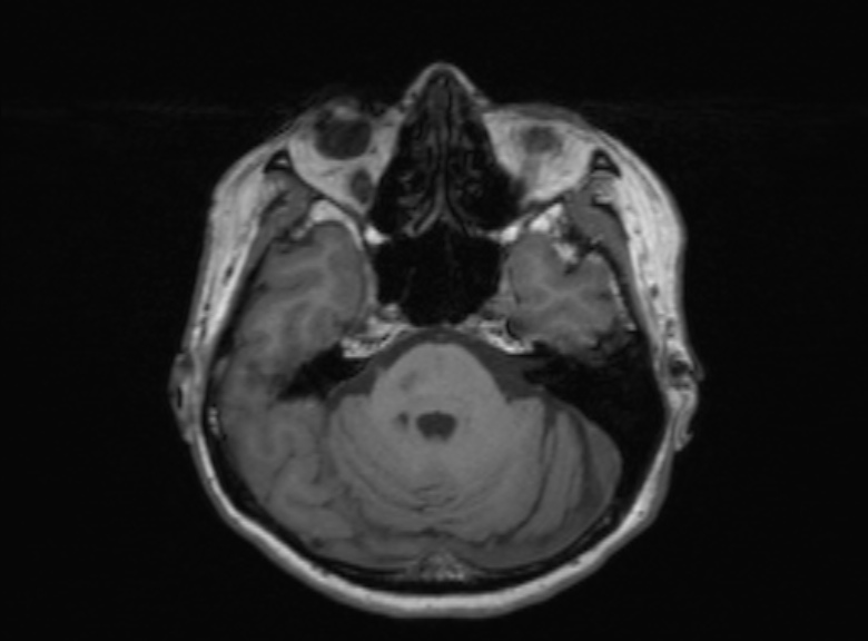 Cerebral ring enhancing lesions - cerebral metastases (Radiopaedia 44922-48817 Axial T1 290).jpg