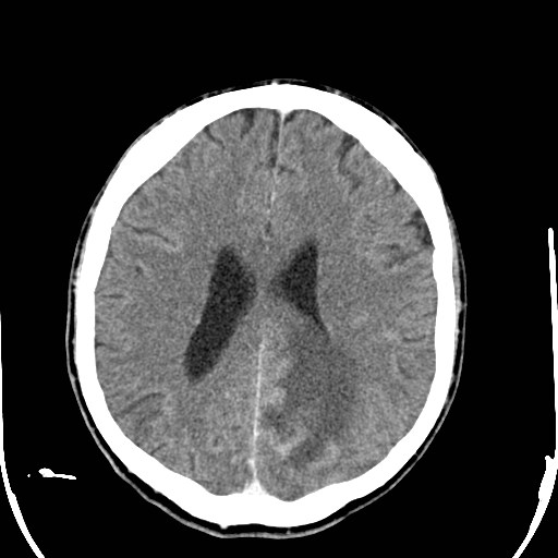 File:Cerebral toxoplasmosis (Radiopaedia 43956-47460 Axial C+ delayed 25).jpg
