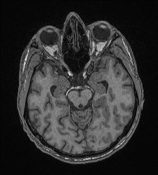 File:Cerebral toxoplasmosis (Radiopaedia 43956-47461 Axial T1 28).jpg