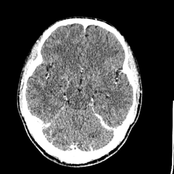 File:Cerebral toxoplasmosis (Radiopaedia 53993-60131 Axial C+ delayed 29).jpg