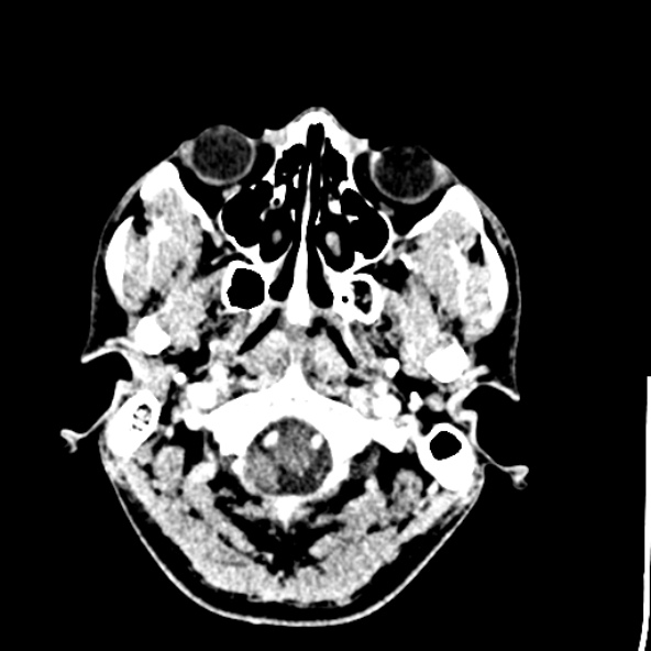Cerebral toxoplasmosis (Radiopaedia 53993-60131 Axial C+ delayed 8).jpg