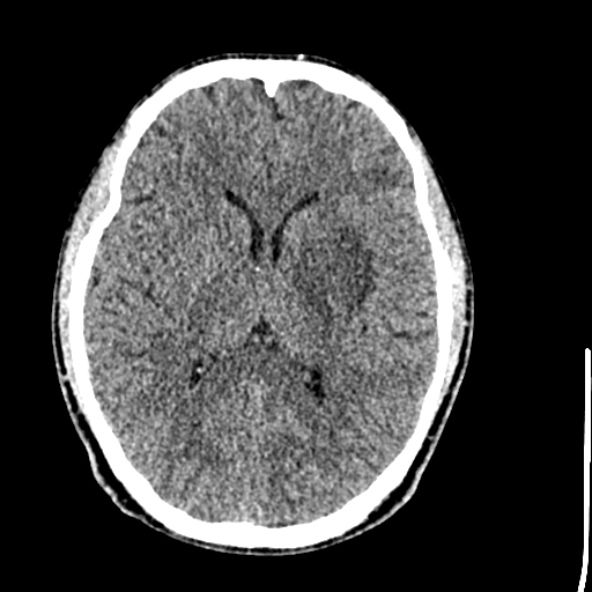 Cerebral toxoplasmosis (Radiopaedia 53993-60131 Axial non-contrast 43).jpg