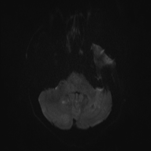 Cerebral toxoplasmosis (Radiopaedia 53993-60132 Axial DWI 33).jpg