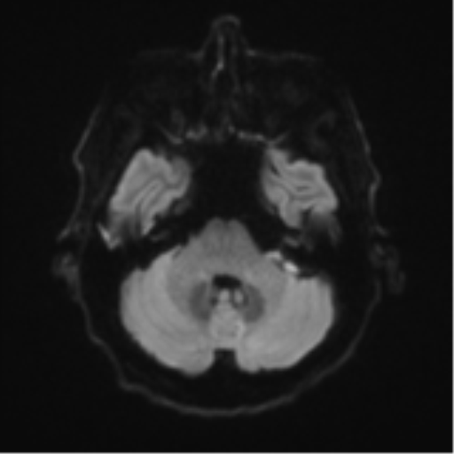 Cerebral toxoplasmosis (Radiopaedia 54575-60804 Axial DWI 42).png
