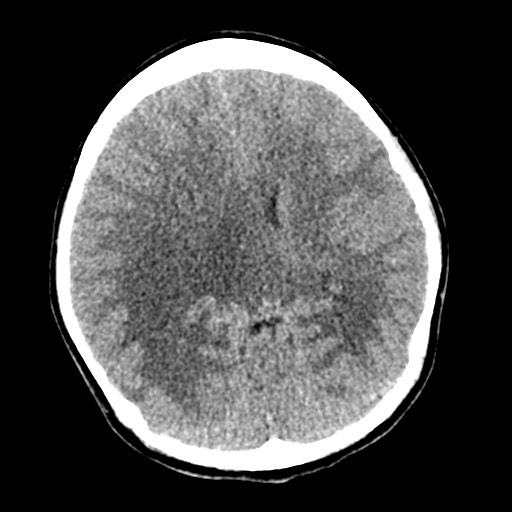 Cerebral tuberculosis with dural sinus invasion (Radiopaedia 60353-68018 Axial non-contrast 32).jpg