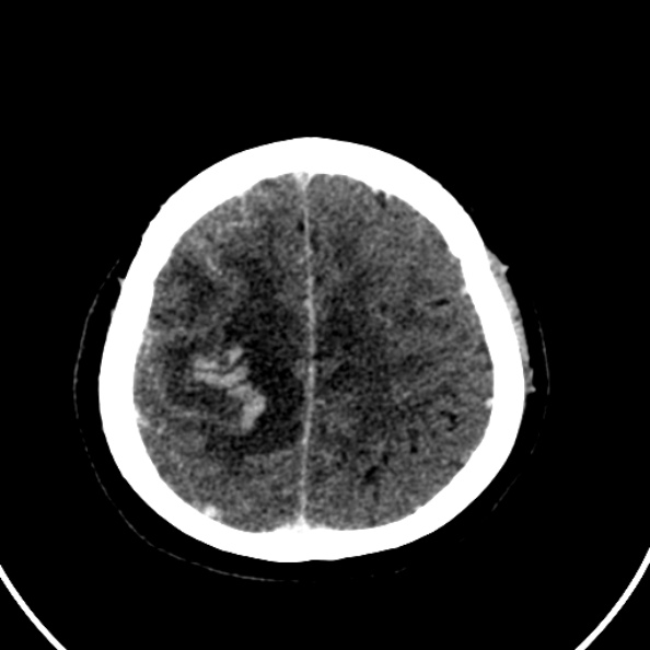 File:Cerebral venous hemorrhagic infarct from venous sinus thrombosis (Radiopaedia 55433-61883 Axial C+ delayed 35).jpg