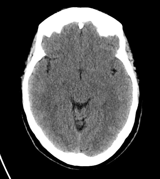 File:Cerebral venous infarct related to dural venous sinus thromboses (Radiopaedia 35292-36804 Axial non-contrast 13).png