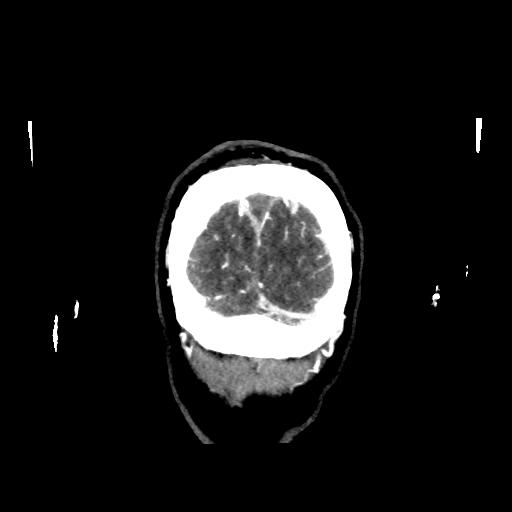 File:Cerebral venous throbmosis - hemorrhagic venous infarction (Radiopaedia 87318-103613 Coronal CT venogram 40).jpg