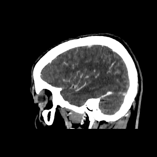 File:Cerebral venous thrombosis (CVT) (Radiopaedia 77524-89685 Sagittal CTV 37).jpg