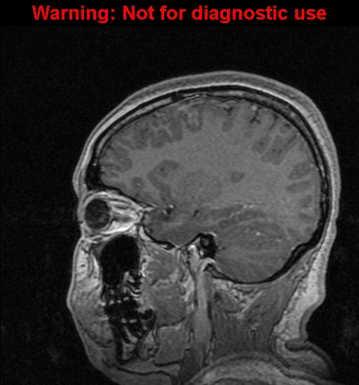 Cerebral venous thrombosis (Radiopaedia 37224-39208 Sagittal T1 C+ 48).jpg