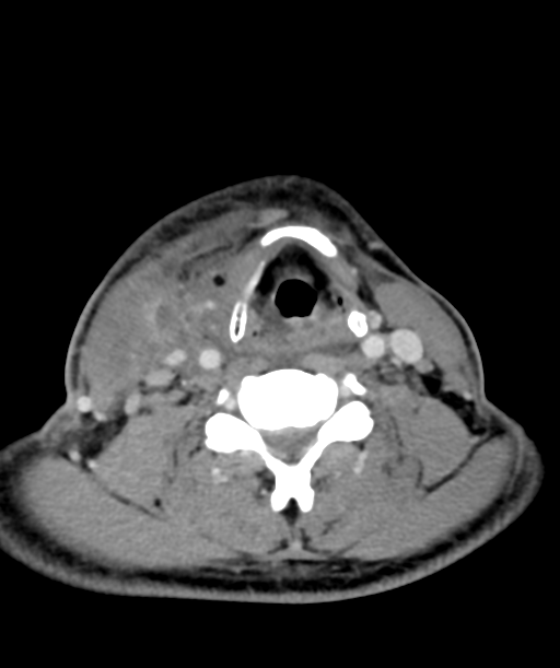 Cervical abscess (Radiopaedia 43725-47184 A 42).png